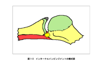 インピンジメント